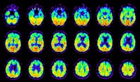 Attività metabolica nel cervello di un paziente affetto da demenza fronto-temporale